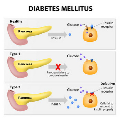 Breakdown of Different types of diabetes